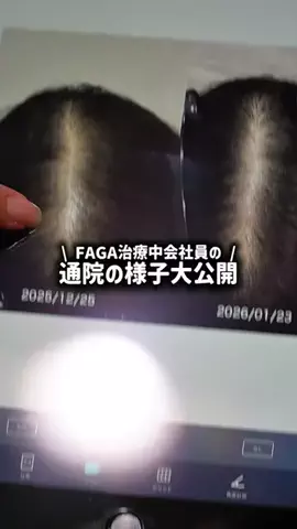 FAGAを改善する会社員のTikTok投稿