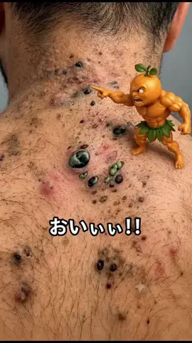 ニキビの本音のTikTok投稿