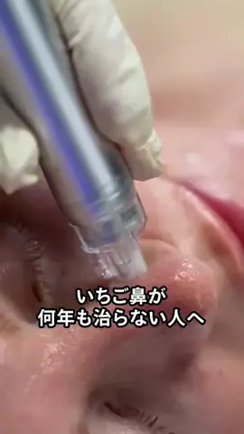 ニキビの本音のTikTok投稿