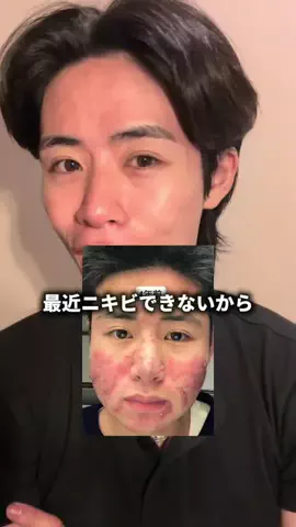 案件で汚肌を綺麗にする大学生（アケオハ大学生）のTikTok投稿