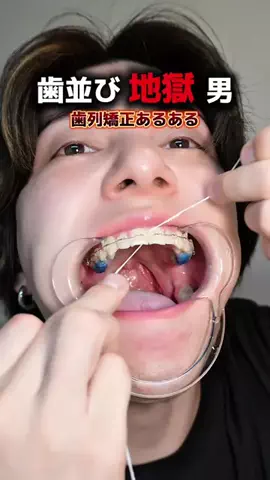 がんこちゃん🐊｜歯列矯正中のTikTok投稿